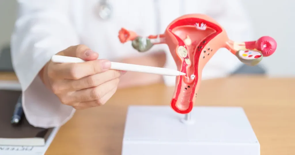 Ovarian Cyst Symptoms